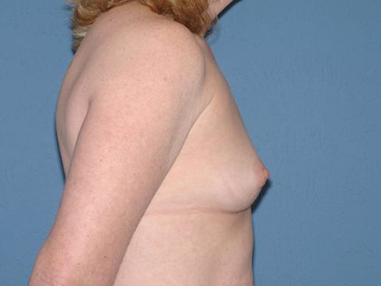 Breast Implants - Breast Augmentation Before & After Patient #2116