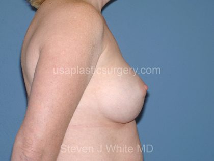 Breast Implants - Breast Augmentation Before & After Patient #2116