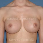 Breast Implants - Breast Augmentation Before & After Patient #2117
