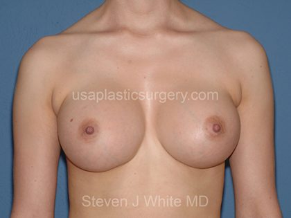 Breast Implants - Breast Augmentation Before & After Patient #2117