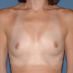 Breast Implants - Breast Augmentation Before & After Patient #2118