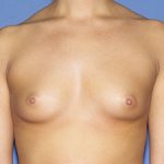 Breast Implants - Breast Augmentation Before & After Patient #2119