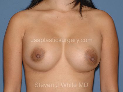 Breast Implants - Breast Augmentation Before & After Patient #4468