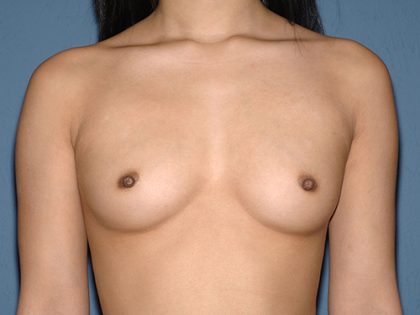 Breast Implants - Breast Augmentation Before & After Patient #4467