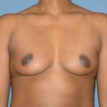 Breast Implants - Breast Augmentation Before & After Patient #4465