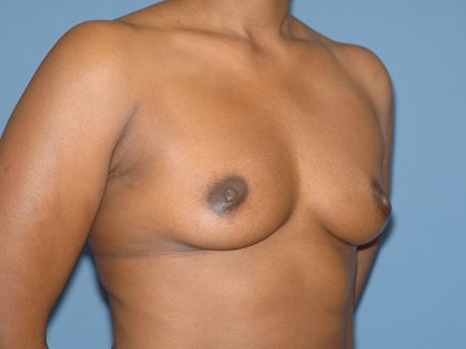 Breast Implants - Breast Augmentation Before & After Patient #4465