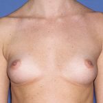 Breast Implants - Breast Augmentation Before & After Patient #4464