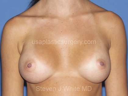 Breast Implants - Breast Augmentation Before & After Patient #4464