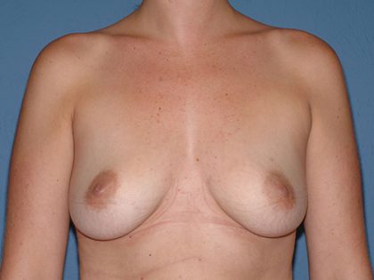 Breast Implants - Breast Augmentation Before & After Patient #4463