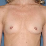 Breast Implants - Breast Augmentation Before & After Patient #4462