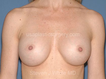 Breast Implants - Breast Augmentation Before & After Patient #4462
