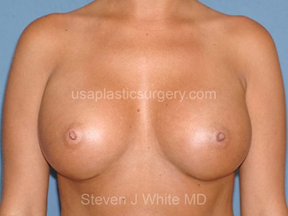 Breast Implants - Breast Augmentation Before & After Patient #4461