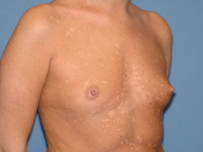 Breast Implants - Breast Augmentation Before & After Patient #4461