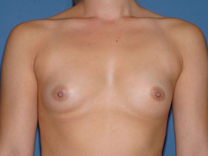Breast Implants - Breast Augmentation Before & After Patient #4460