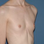 Breast Implants - Breast Augmentation Before & After Patient #4459