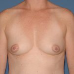 Breast Implants - Breast Augmentation Before & After Patient #4458