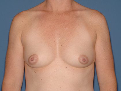 Breast Implants - Breast Augmentation Before & After Patient #4458
