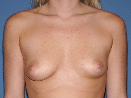 Breast Implants - Breast Augmentation Before & After Patient #4420