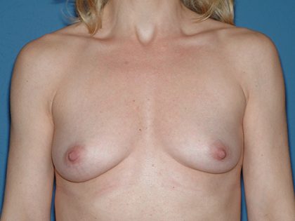 Breast Implants - Breast Augmentation Before & After Patient #4418
