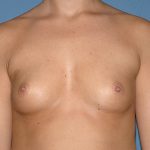 Breast Implants - Breast Augmentation Before & After Patient #4417