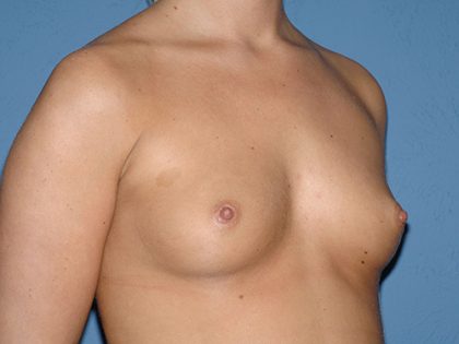 Breast Implants - Breast Augmentation Before & After Patient #4417