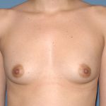 Breast Implants - Breast Augmentation Before & After Patient #1883