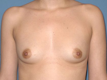 Breast Implants - Breast Augmentation Before & After Patient #1883