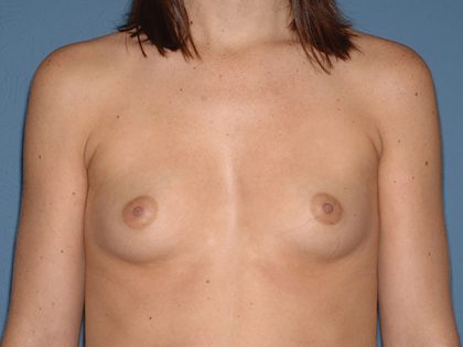 Breast Implants - Breast Augmentation Before & After Patient #4355