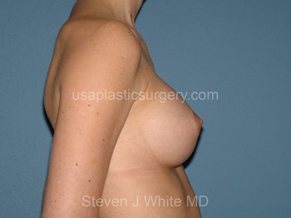 Breast Implants - Breast Augmentation Before & After Patient #4355