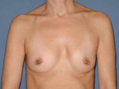 Breast Implants - Breast Augmentation Before & After Patient #4354
