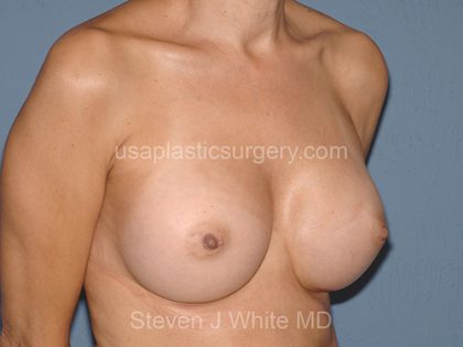 Breast Implants - Breast Augmentation Before & After Patient #4354