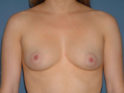 Breast Implants - Breast Augmentation Before & After Patient #4353