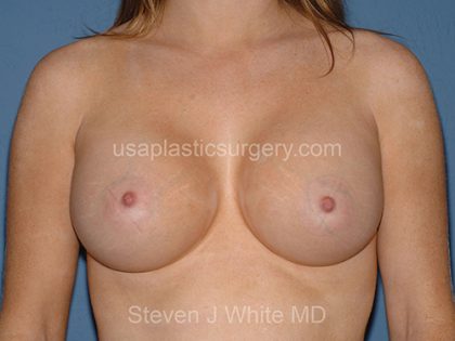 Breast Implants - Breast Augmentation Before & After Patient #4353