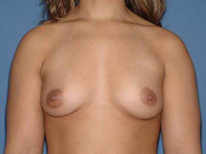 Breast Implants - Breast Augmentation Before & After Patient #4352