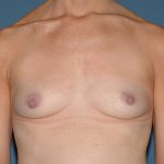 Breast Implants - Breast Augmentation Before & After Patient #4350
