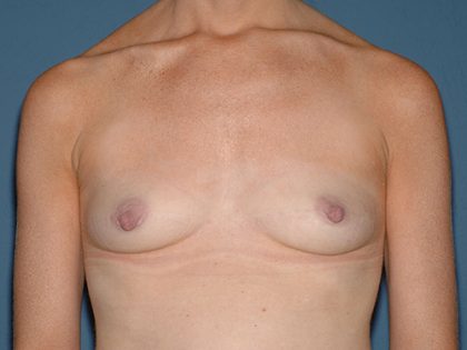 Breast Implants - Breast Augmentation Before & After Patient #4350