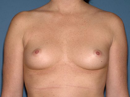 Breast Implants - Breast Augmentation Before & After Patient #4348