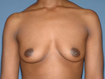 Breast Implants - Breast Augmentation Before & After Patient #4346