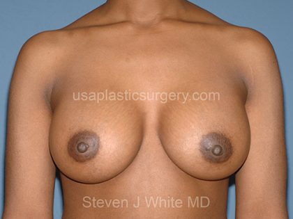 Breast Implants - Breast Augmentation Before & After Patient #4346