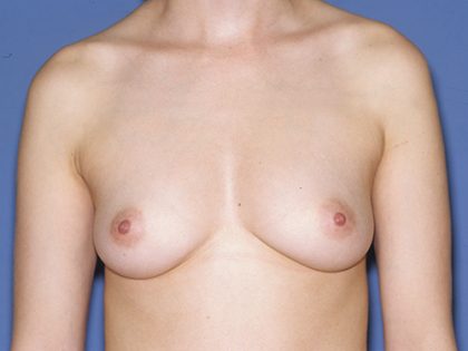 Breast Implants - Breast Augmentation Before & After Patient #1884