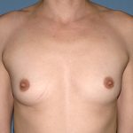 Breast Implants - Breast Augmentation Before & After Patient #4285