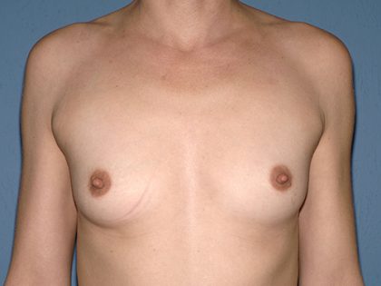 Breast Implants - Breast Augmentation Before & After Patient #4285