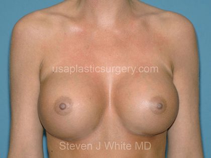 Breast Implants - Breast Augmentation Before & After Patient #4284