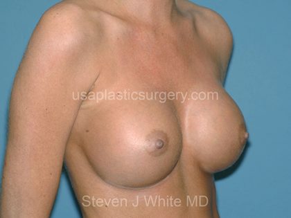Breast Implants - Breast Augmentation Before & After Patient #4284