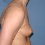 Breast Implants - Breast Augmentation Before & After Patient #4282