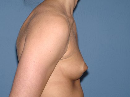 Breast Implants - Breast Augmentation Before & After Patient #4282