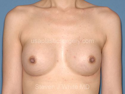 Breast Implants - Breast Augmentation Before & After Patient #4280