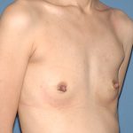 Breast Implants - Breast Augmentation Before & After Patient #4280