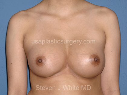 Breast Implants - Breast Augmentation Before & After Patient #4278