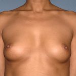 Breast Implants - Breast Augmentation Before & After Patient #4276